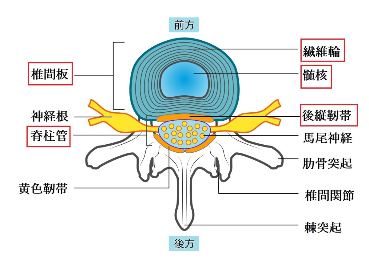 腰椎椎間板ヘルニア　説明　図